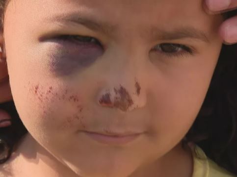 Criança de 5 anos fica ferida após escorregador quebrar em parquinho de escola no Gama